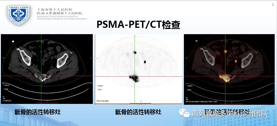 前列腺癌精准诊疗,前列腺癌辅助放疗和挽救放疗
