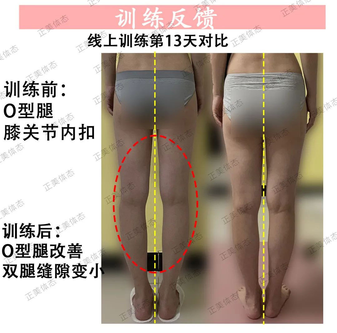 拯救腿型,o型腿睡觉姿势改善腿型