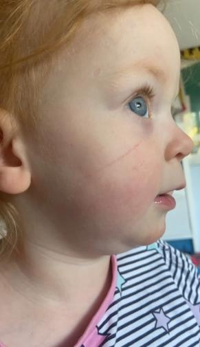 被蝙蝠咬打狂犬疫苗吗,2岁宝宝被猫抓伤了打狂犬疫苗吗