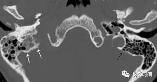双侧颈动脉鞘间隙多发小淋巴结影,双侧颈动脉间隙多软组织密度结节