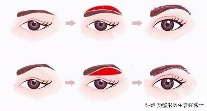 上眼皮松弛的解决办法,眼皮松了变成三角眼怎么解决