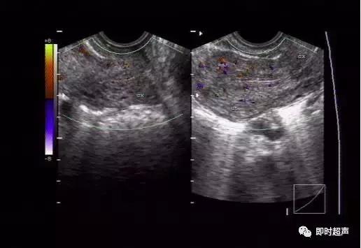 妇科阴式超声检查方法,盆底超声可检查什么疾病
