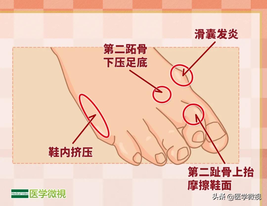 大脚骨严重畸形,大脚骨的最新治疗方法