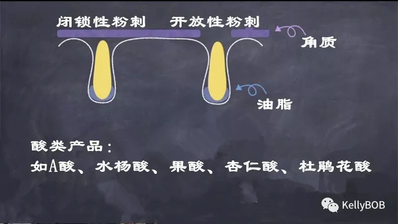 痘痘肌怎么去除粉刺和痘印,如何拯救痘痘肌肤再也不长痘痘