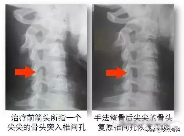 颈椎病治疗的十大误区,颈椎病4大治疗误区你知道吗
