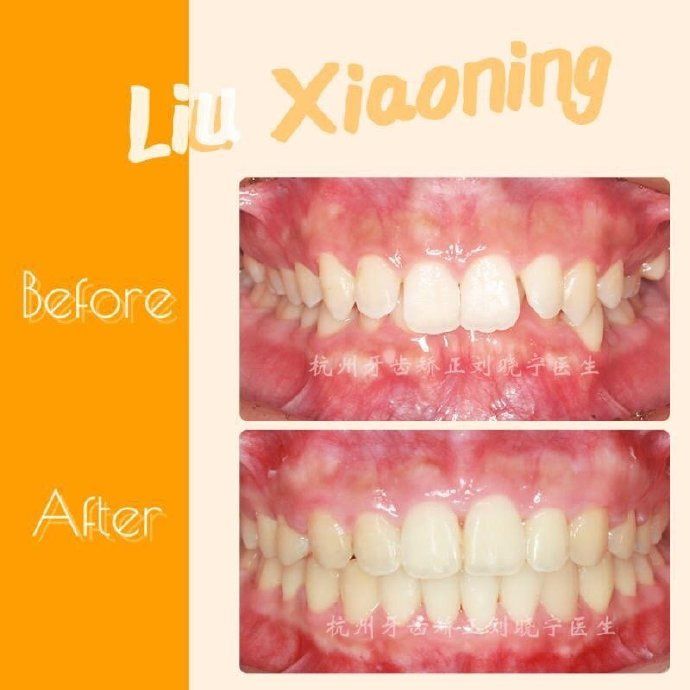 杭州舌侧牙齿矫正,舌侧矫正杭州价格