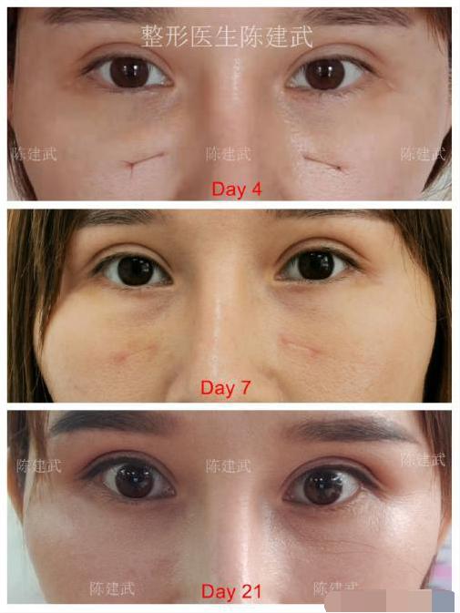 怎么样区分眼袋和泪沟,怎么区分泪沟和眼袋