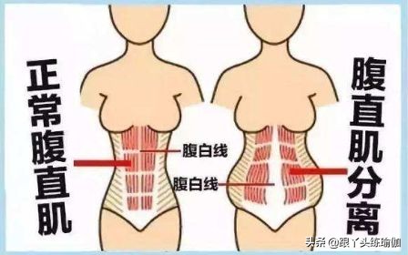 产后腹直肌分离修复手法教程,腹直肌分离瑜伽好还是电疗好