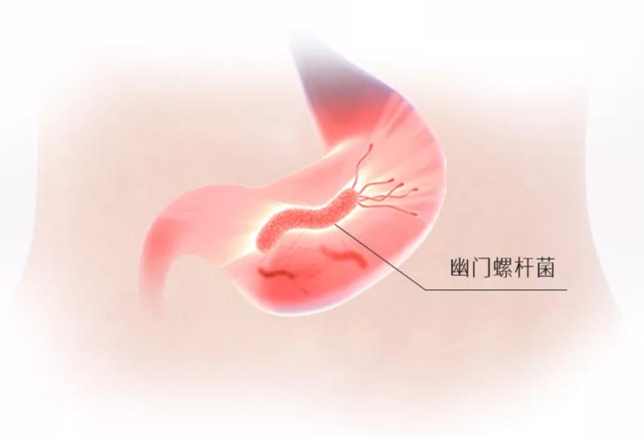 感染幽门螺杆菌只吃甲硝唑有用吗,感染幽门杆菌只能吃药吗