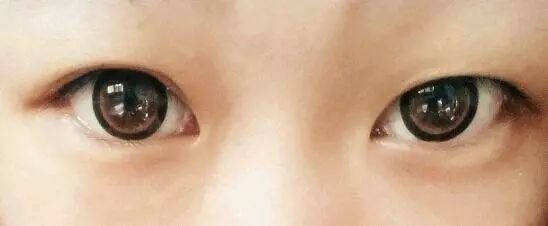 宝宝双眼皮消失的原因,做完全切双眼皮拉扯感多久会消失