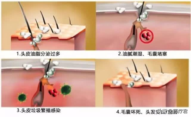 头发一天不洗就很油还有小颗粒,头发一天不洗就冒油