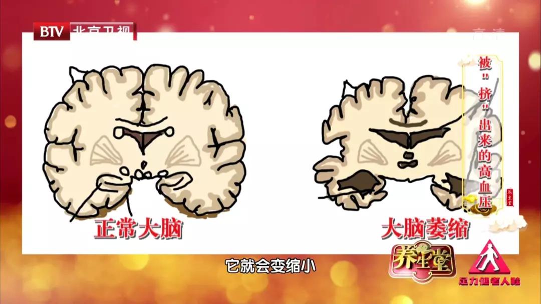 眼皮跳财运到?当心是一种特殊高血压!专家:用一块棉垫就能治愈