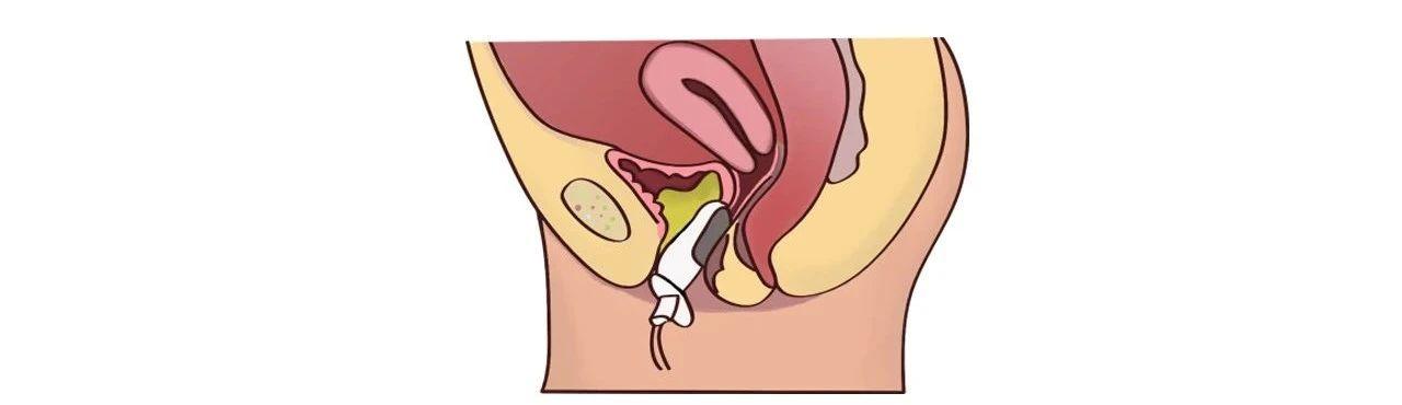 生完孩子盆底康复治疗有必要做吗,生完孩子后有必要做盆底康复