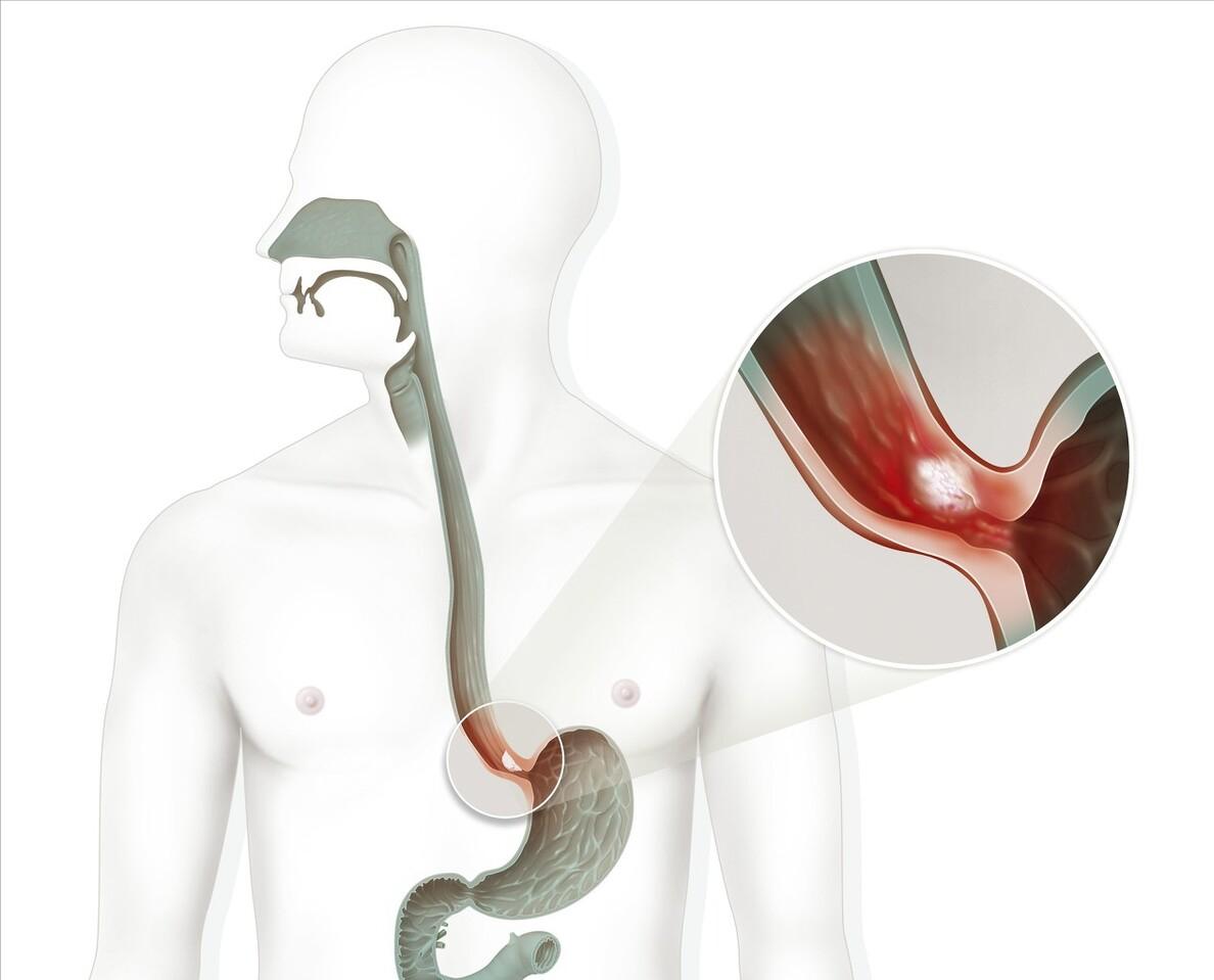 内科、外科齐上阵，“联手”解决Barrett食管
