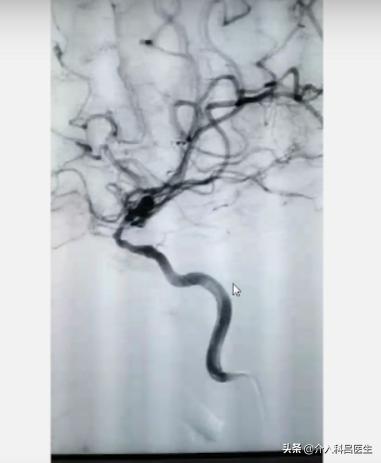 脑袋里有个血管瘤可以微创吗,脑血管瘤医生建议不用做手术