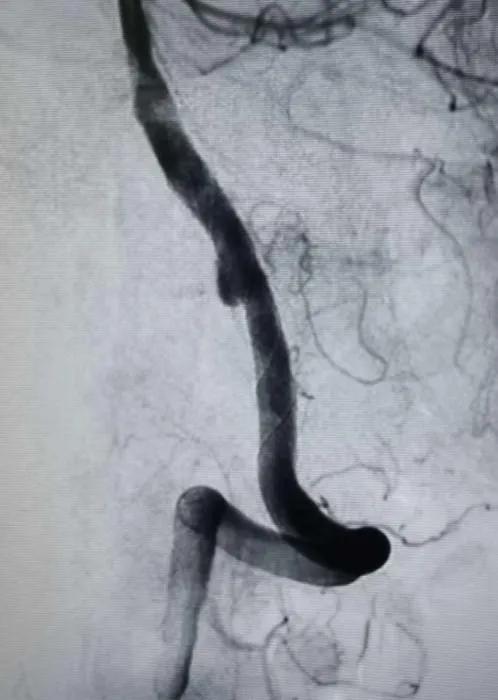 淄博市中心医院治疗动脉瘤,tubridge动脉瘤支架医保报销多少