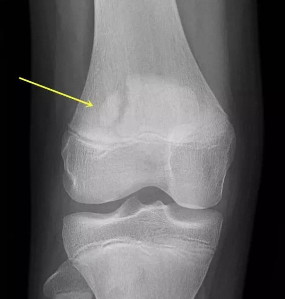 膝盖痛髌骨上方有裂开要手术吗,膝盖髌骨后面突然像针扎一样疼