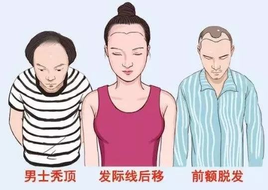 女性发际线后移是什么原因导致的,女人发际线越来越高意味着什么