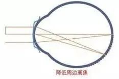 角膜塑形镜控制近视发展的效果,角膜塑形镜控制近视效果如何