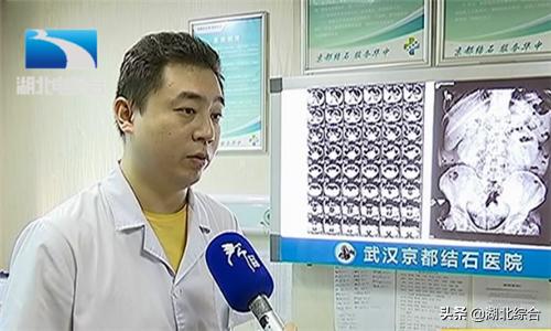 男子患肾结石八年未及时治疗,右肾多发结石并右肾严重积水