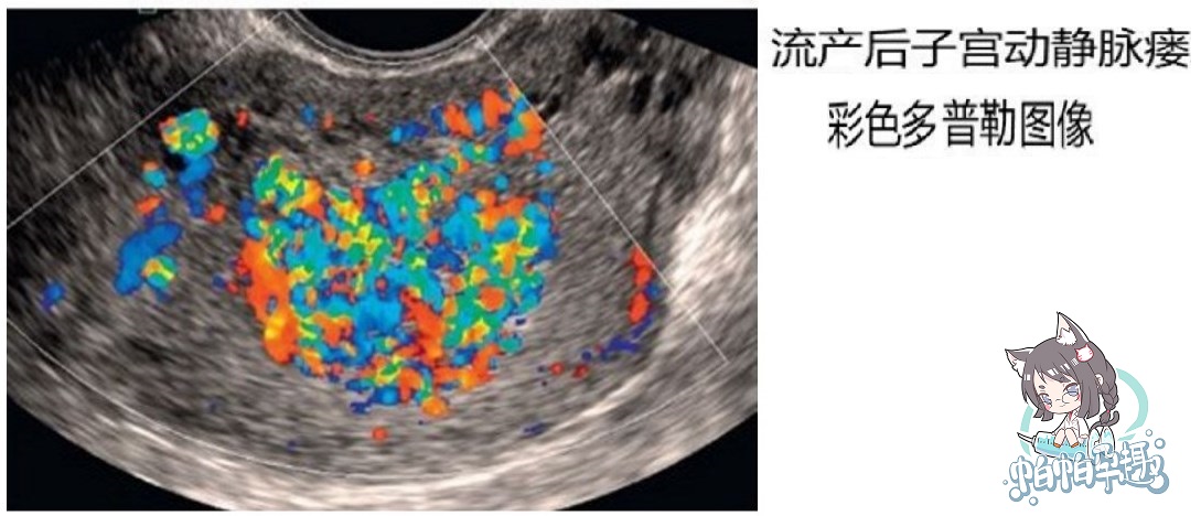 流产导致的动静脉瘘能治愈吗,流产不干净形成血管瘘