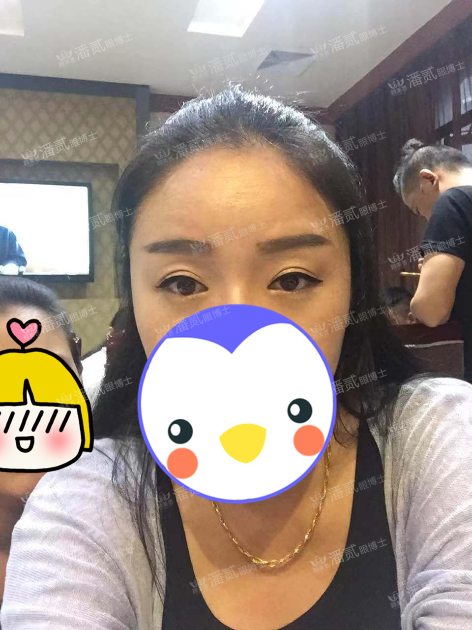 提肌矫正失败的表现眼皮睁不开,做完提肌眼睛前半段下垂