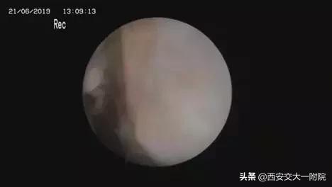 中老年骨性膝关节炎的最好治疗,骨关节是中老年残疾第一大杀手