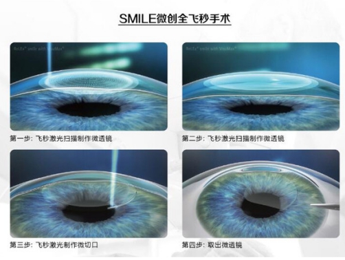 个体化半飞秒和标准化飞秒哪个好,个性化半飞秒技术和全飞秒哪个好