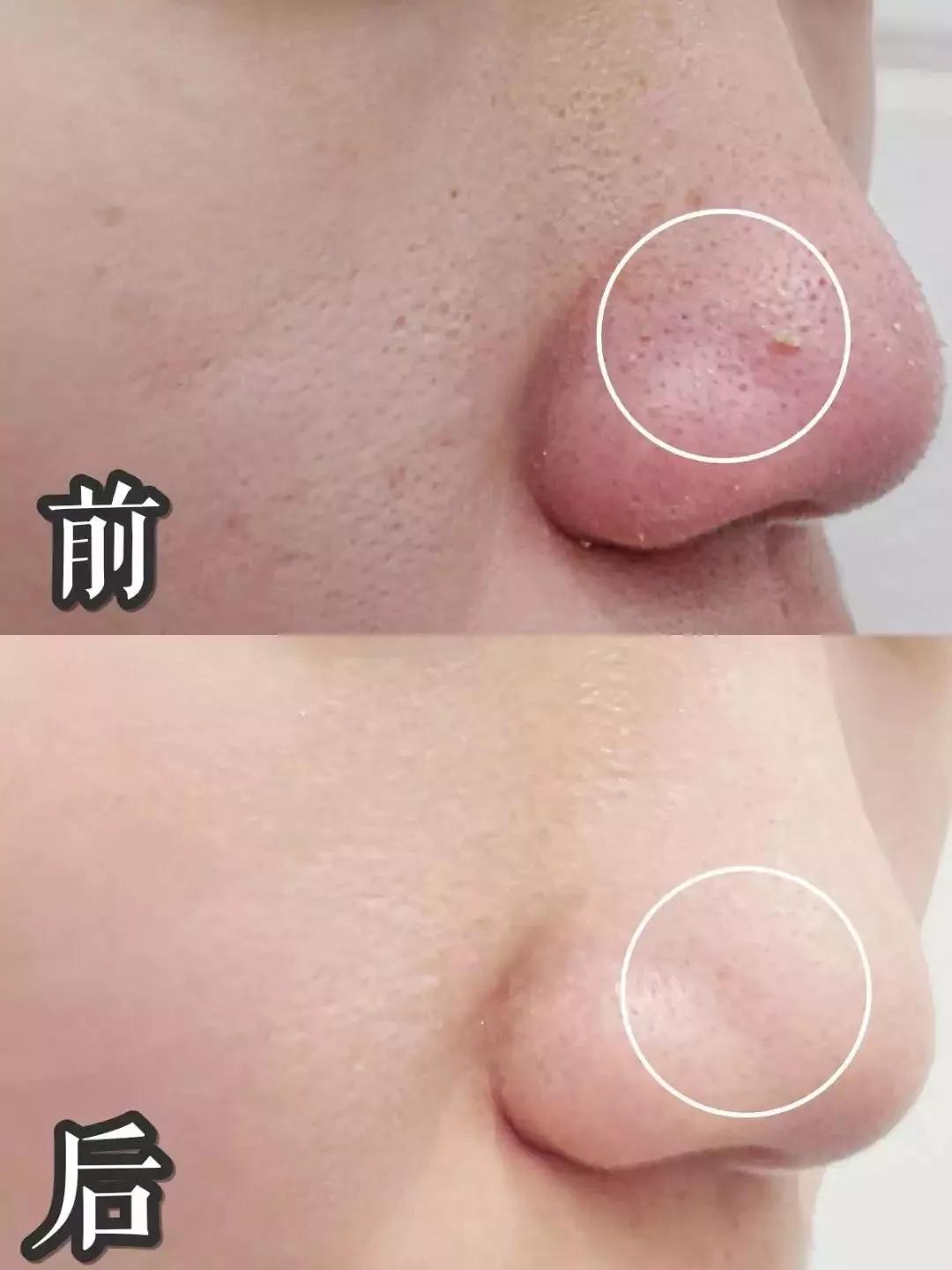 隐藏款改善黑头洗面奶,用完不长黑头和扩大毛孔的洗面奶