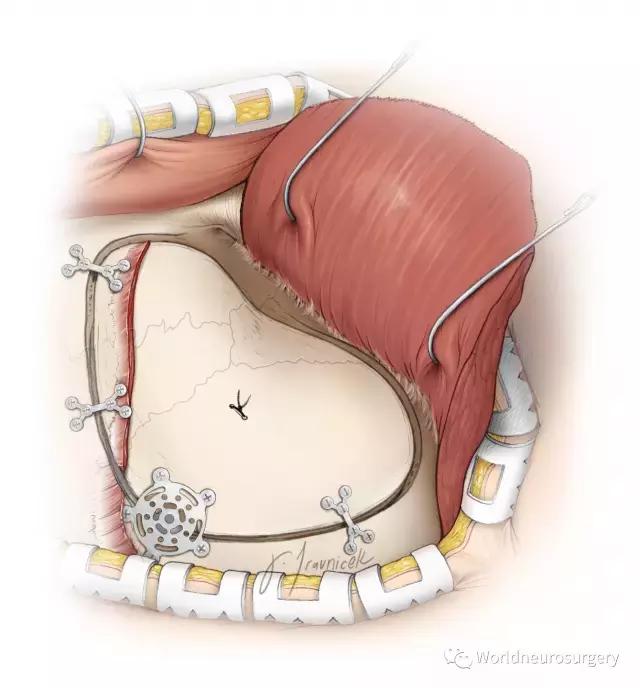 翼点入路技巧图解,翼点入路的开颅要点