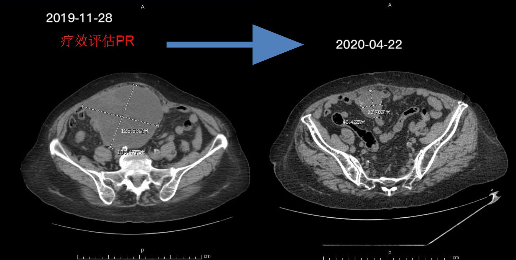 卵巢肿瘤早期化疗会治愈吗,卵巢肿瘤剥离后化疗