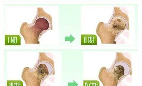 儿童股骨头坏死属于什么科,股骨头缺血性坏死一期应注意什么