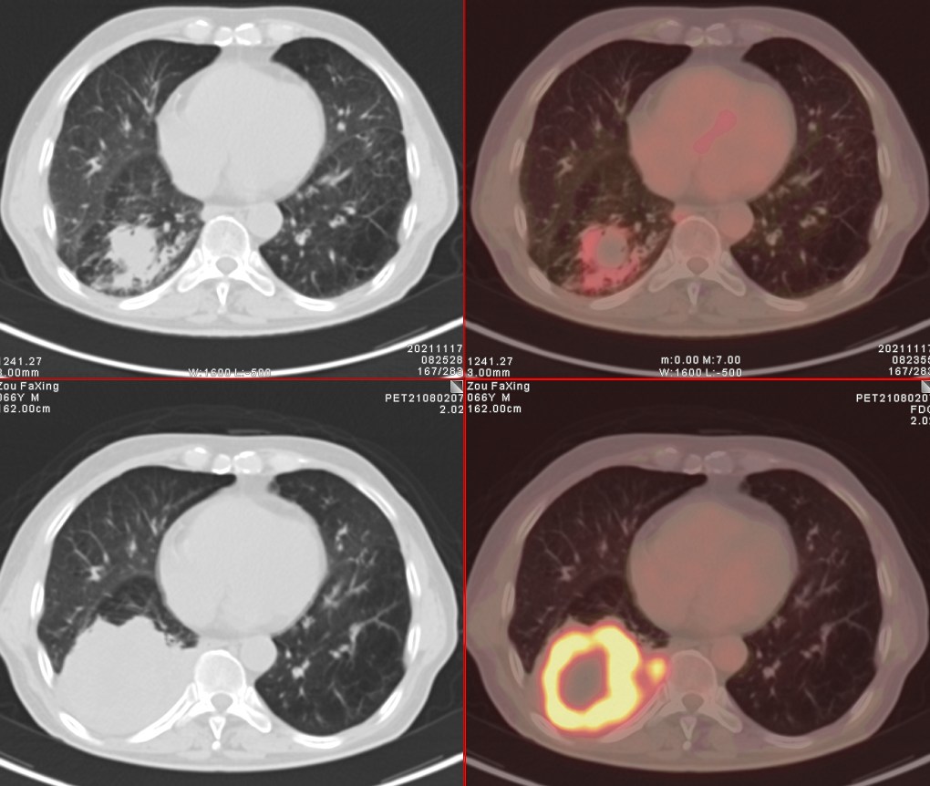 petct肺癌晚期必须要做吗,肺癌患者petct