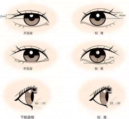 宝宝双眼皮消失的原因,做完全切双眼皮拉扯感多久会消失