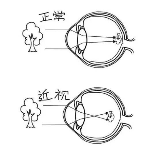 眼科医院检查屈光不正什么意思,眼科中屈光不正是什么意思