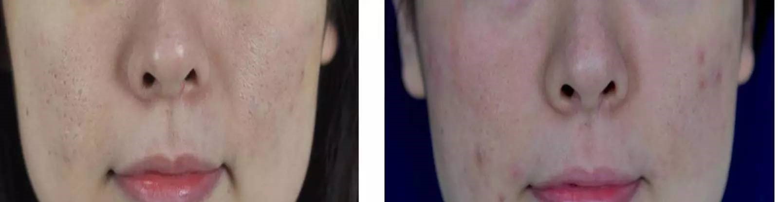 痘坑可以通过护肤手段平复吗,痘坑如何正规治疗