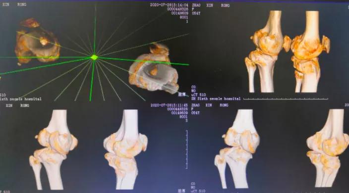 股骨和胫骨双部位截骨拯救复杂膝关节内翻畸形