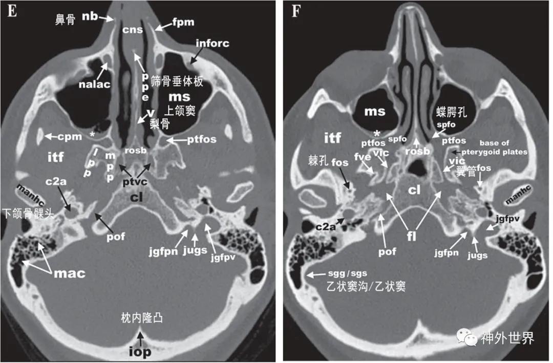 颅底骨折合并脑脊液漏伤情鉴定,颅底骨折伴脑脊液漏右眼眶骨折