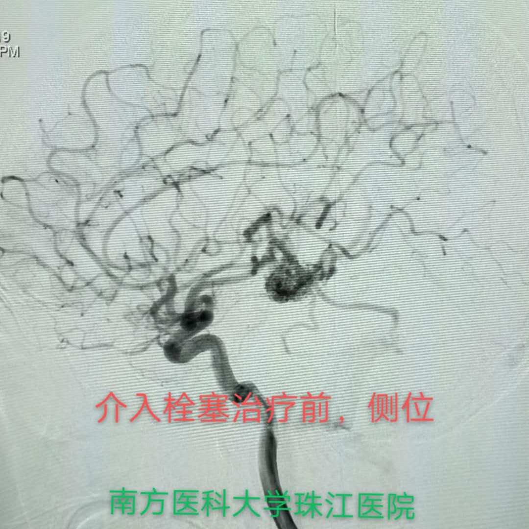 脑动静脉畸形可选用的栓塞物,脑动静脉畸形做伽玛刀后康复