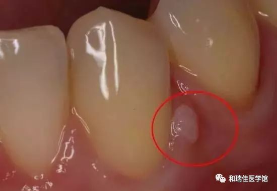 牙龈反复长脓包怎么消除最快方法,根管治疗的牙龈反复长脓包怎么办
