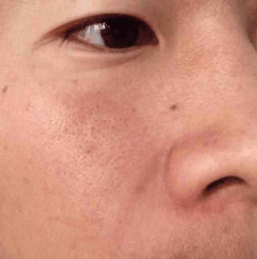 脸颊两边有螨虫用什么东西,螨虫在脸上分泌的物体