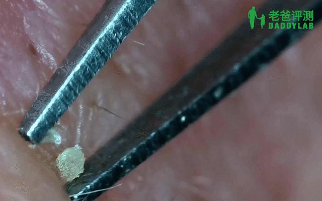 黑头怎么从根部去除,黑头到底怎么去