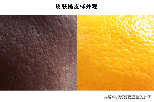 脂肪瘤长得比较快是因为恶变了吗,长了一个脂肪瘤必须赶紧做手术吗