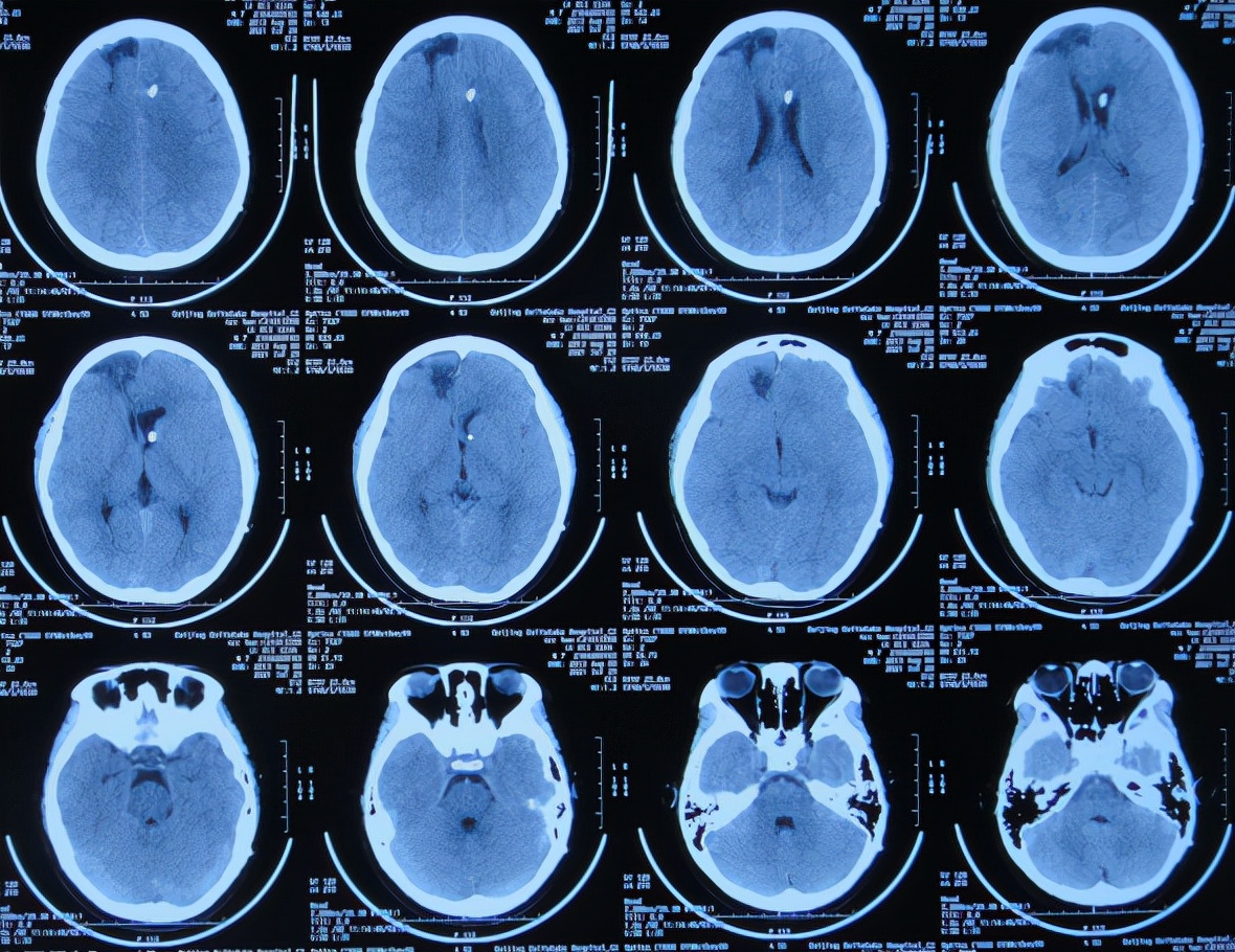 儿童脑出血昏迷三天后恢复正常了,脑出血后脑积水多久会出现症状