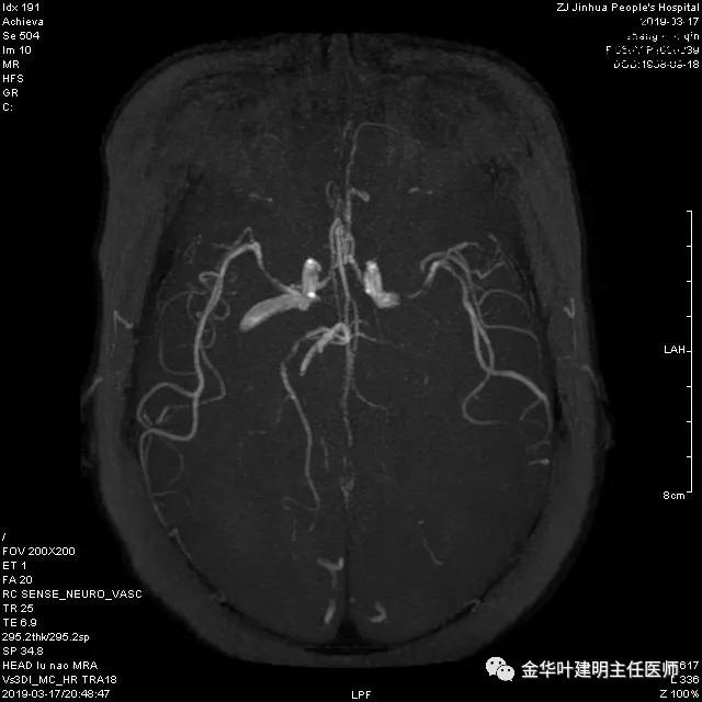 左肺下叶恶性病变,左肺上叶和下叶都有血管畸形