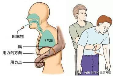海姆立克急救法视频,海姆立克急救法婴儿
