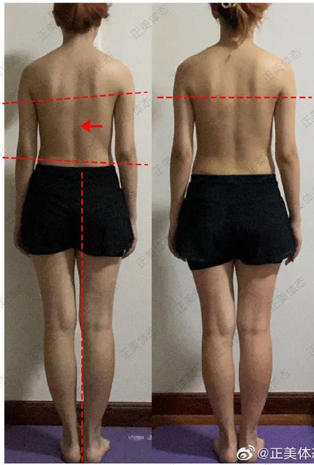 简单脊柱侧弯训练动作两个,1岁脊柱侧弯矫正动作