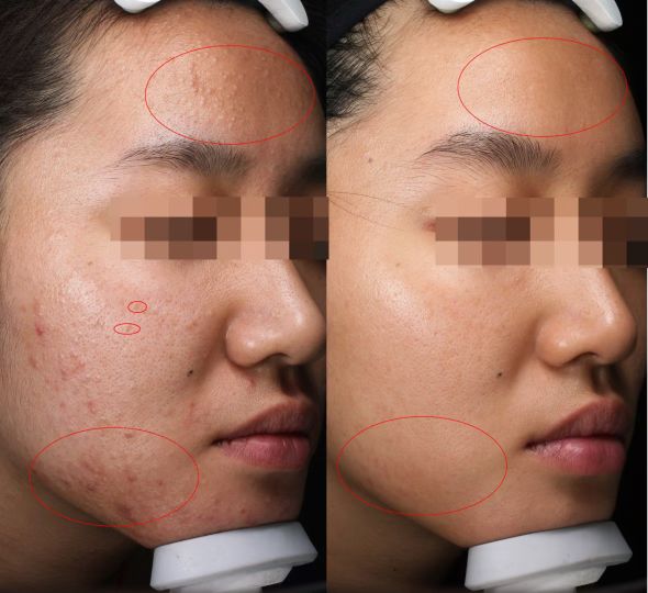 疮是早治好还是晚治好,疮怎么治才能彻底根除