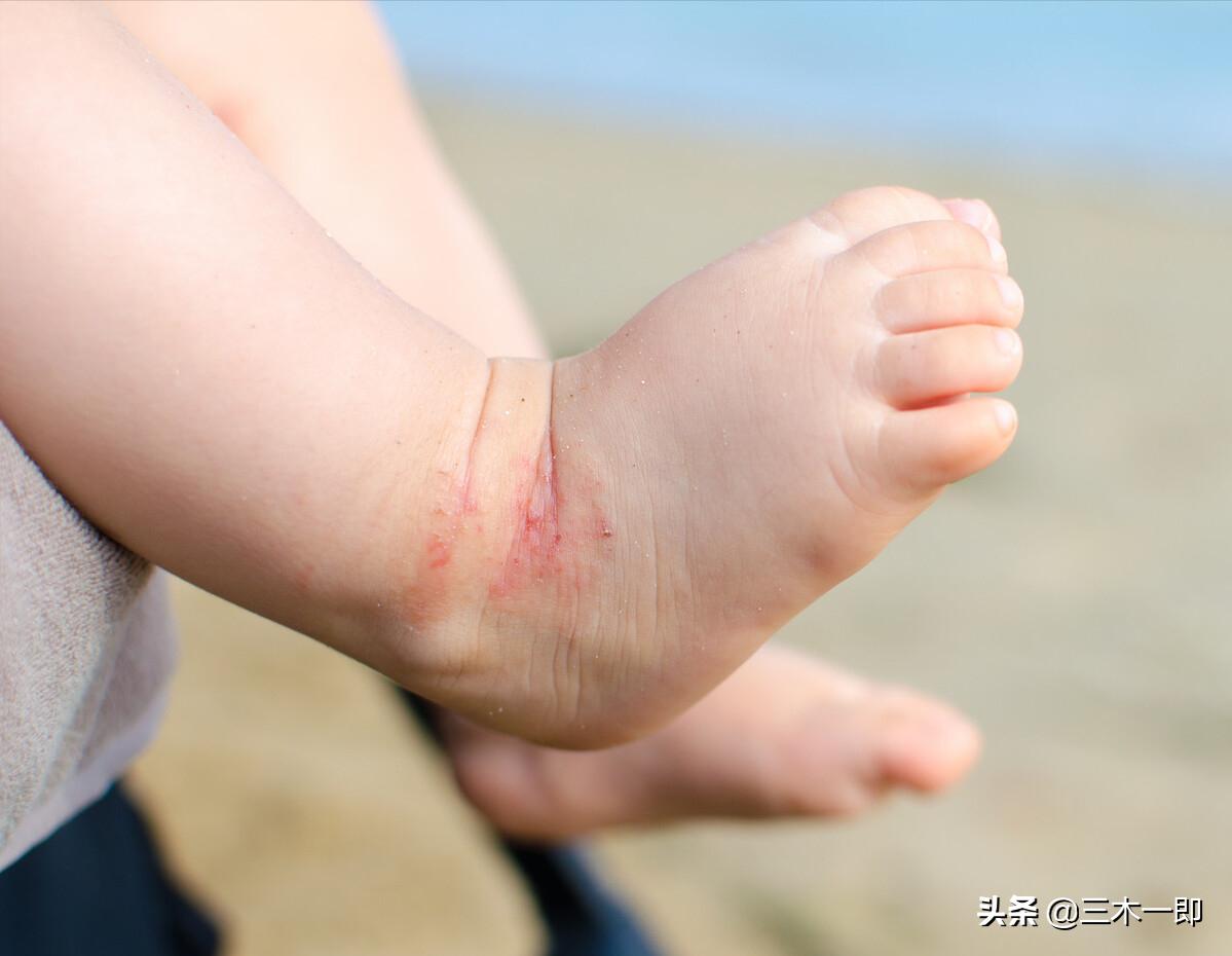 孩子湿疹的原因及处理方法,儿童湿疹治愈过程