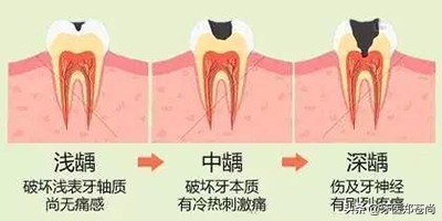 蛀牙深龋不做根管治疗后果,蛀牙一戳很痛是到深龋了吗